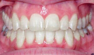 After: Patient with a crossbite and crowding