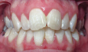 Before: Patient with a crossbite and crowding