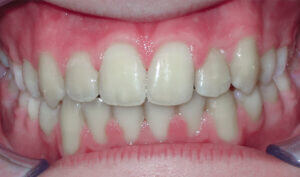 After: Patient with a crossbite and crowding