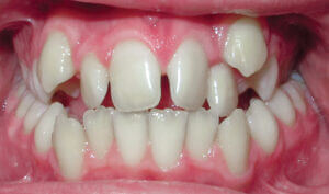 Before: Patient with a crossbite and crowding