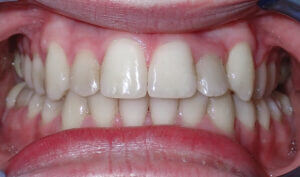 After: Patient with crowding