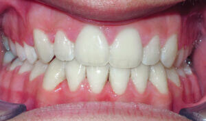 After: Patient with an openbite