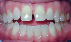 Before: Patient with spacing and an anterior openbite