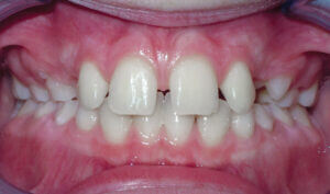 Before: Patient with spacing and an overbite